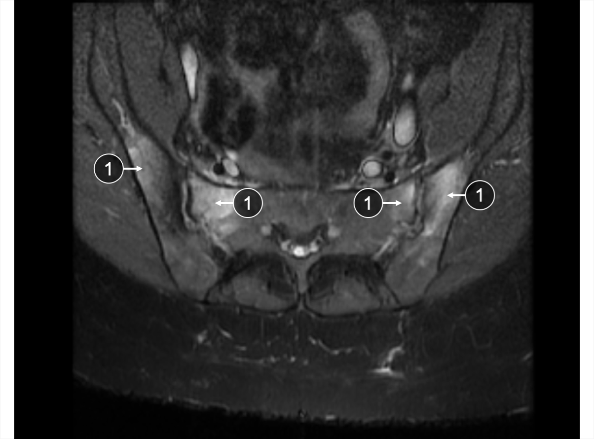 An MRI of SIJ showing bone marrow edema