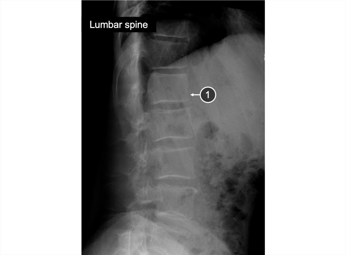 An X-ray of the lumbar spine showing squaring