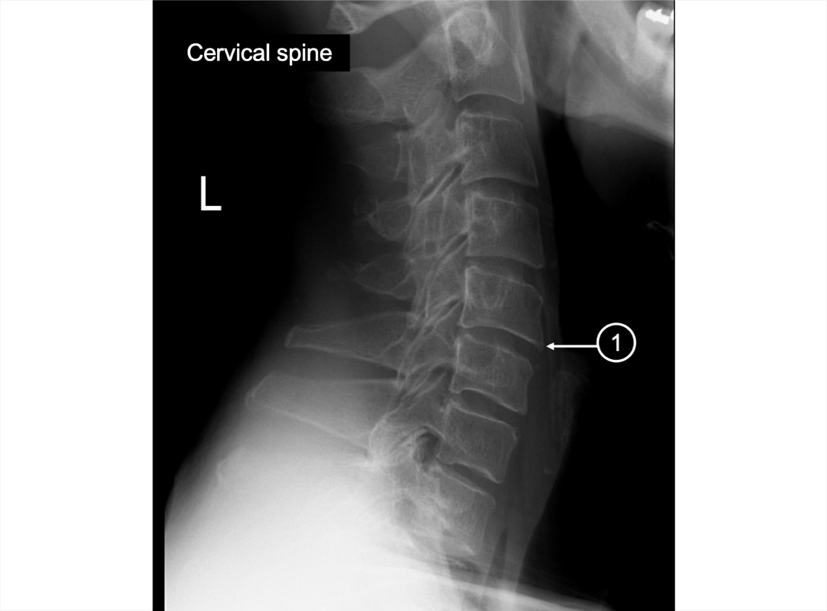 An X-ray of the cervical spine showing small osteophyte