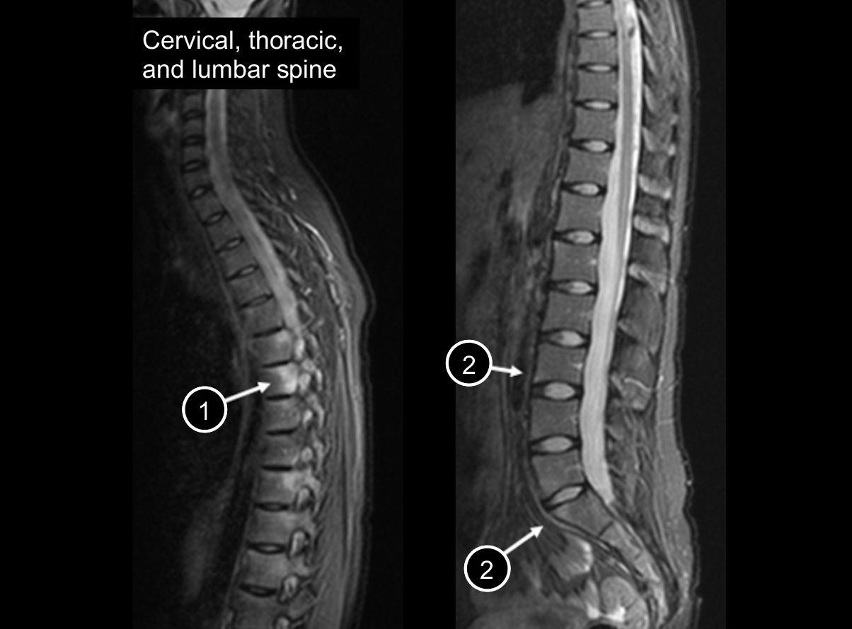 An MRI of the cervical and lumbar spine bone marrow edema