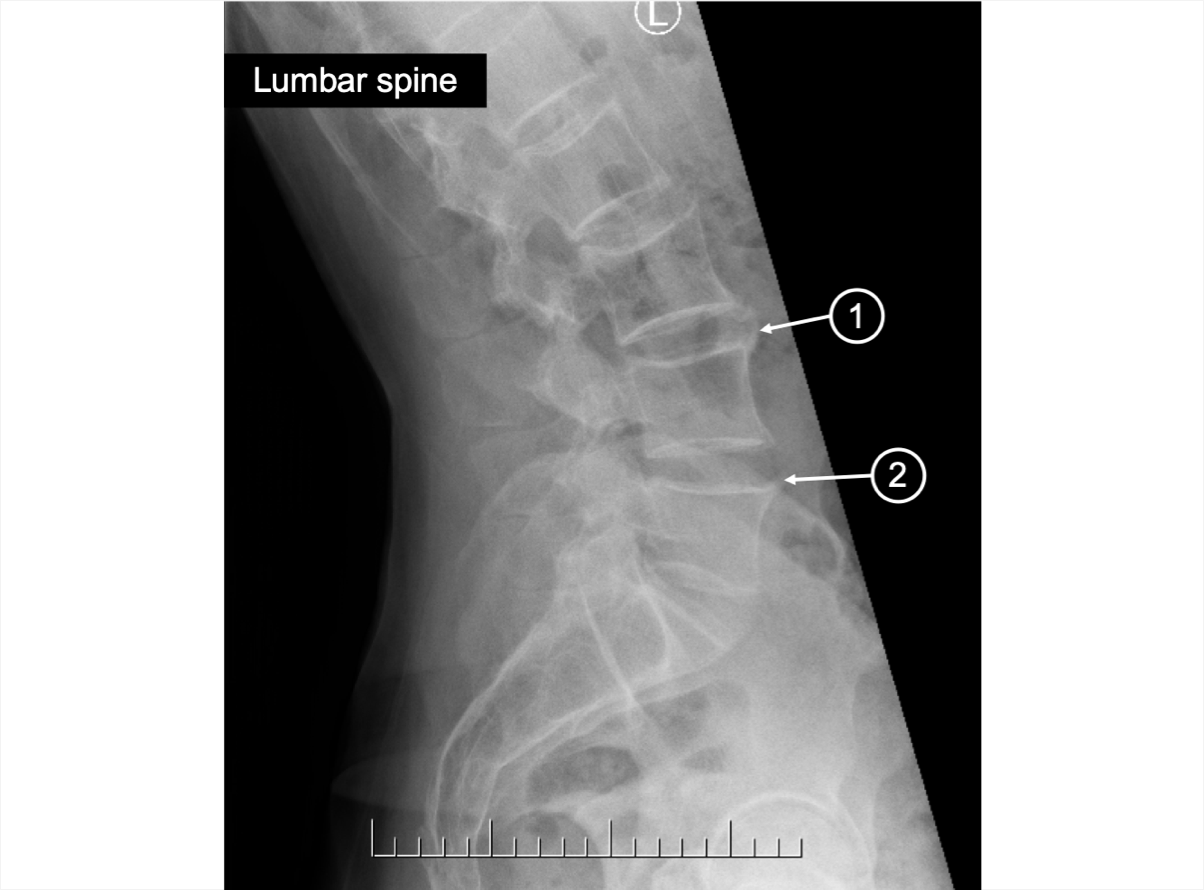 An X-ray of the lumbar spine showing briding of syndesmophyte