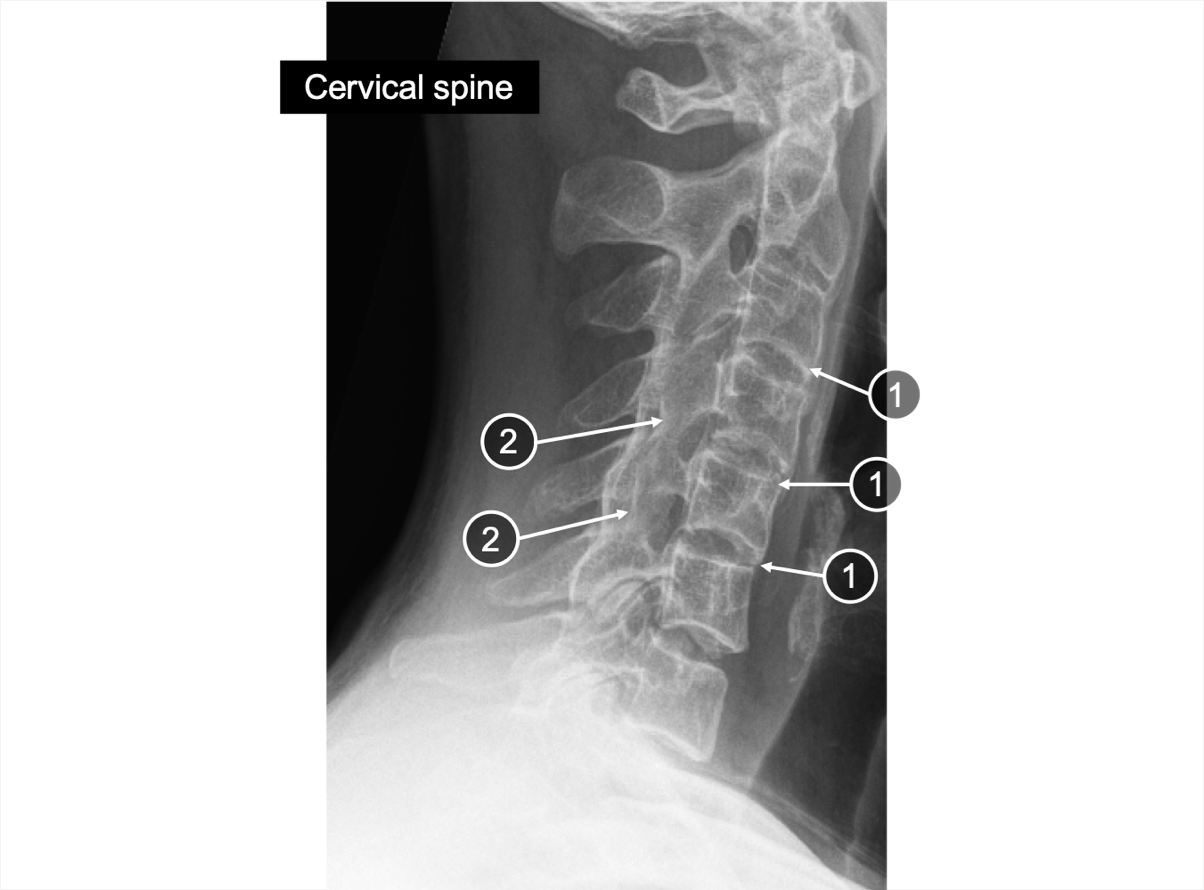 An X-ray of the cervical spine showing briding of syndesmophyte and fused facet joints