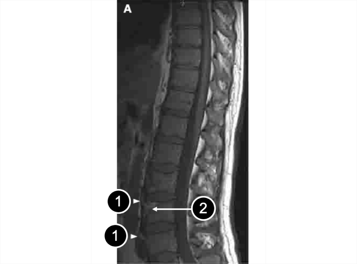 An MRI of the thoracic- lumbar spine showing syndesmophyte and area of inflammation