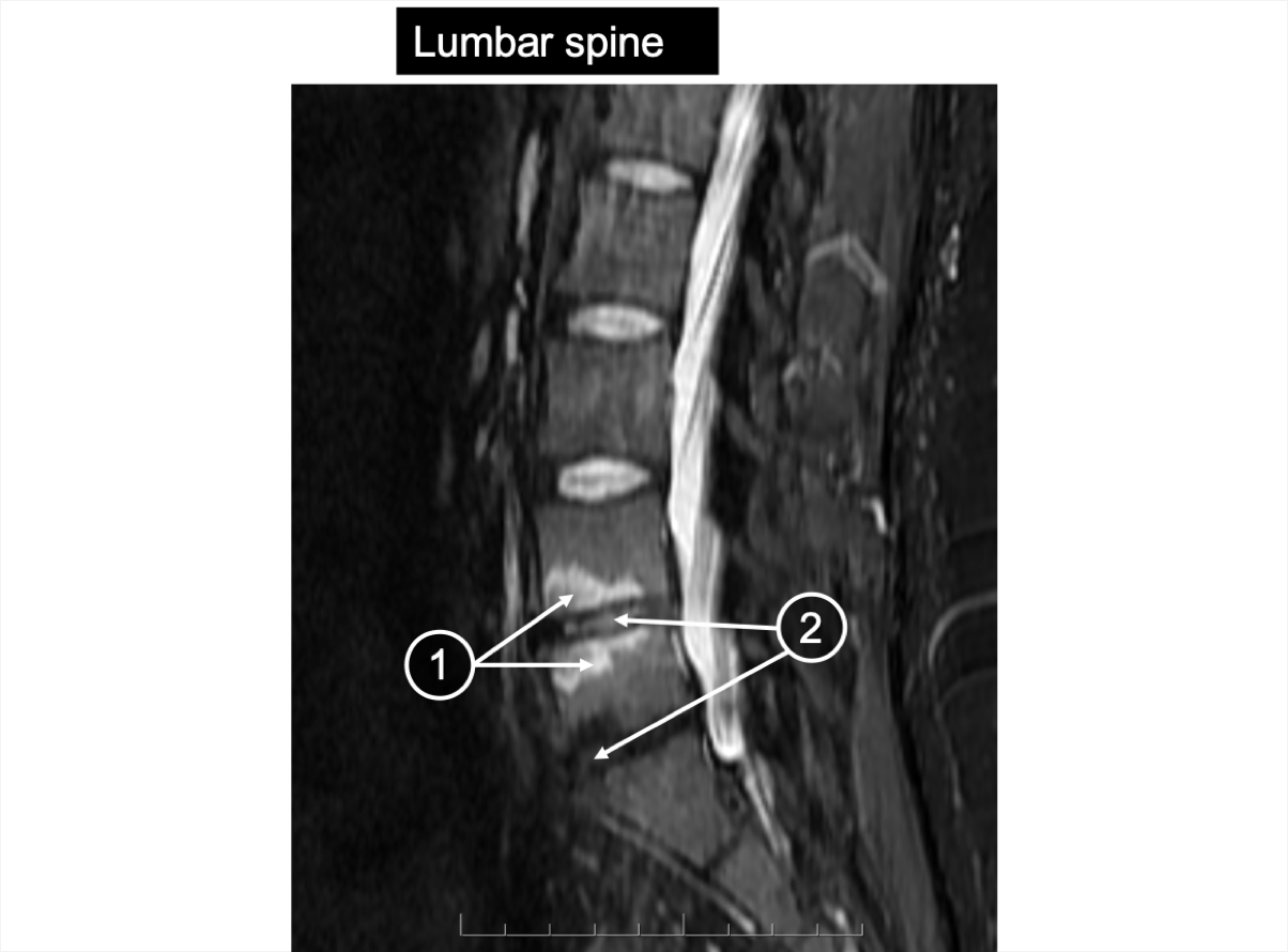 An MRI of the lumbar spine showing bone marrow edema and discitis