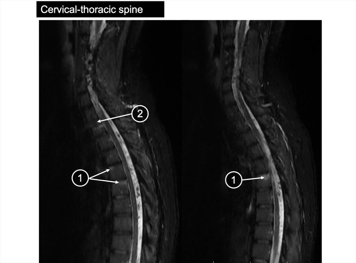 An MRI of the cervical-thoracic spine showing bone marrow edema and discitis