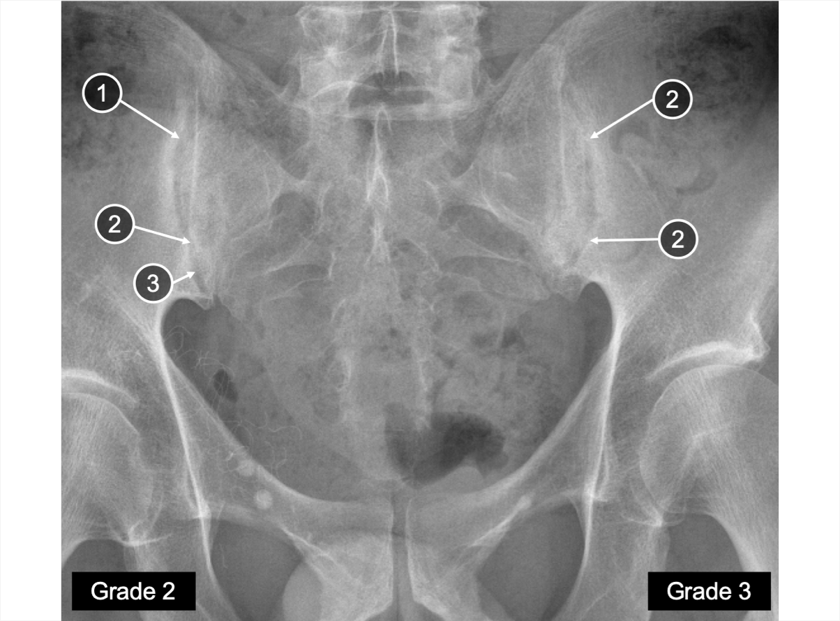 An X-ray of SIJ showing erosion and some narrowing/widening of joint space