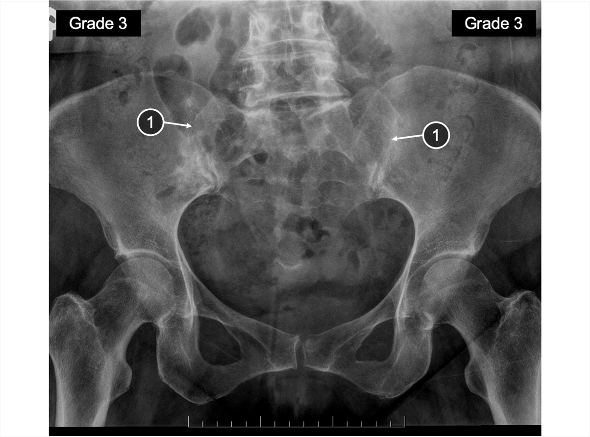 An X-ray of SIJ showing areas of ankylosis