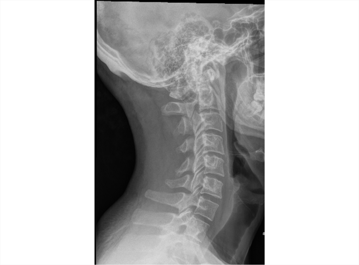 An X-ray of the cervical spine