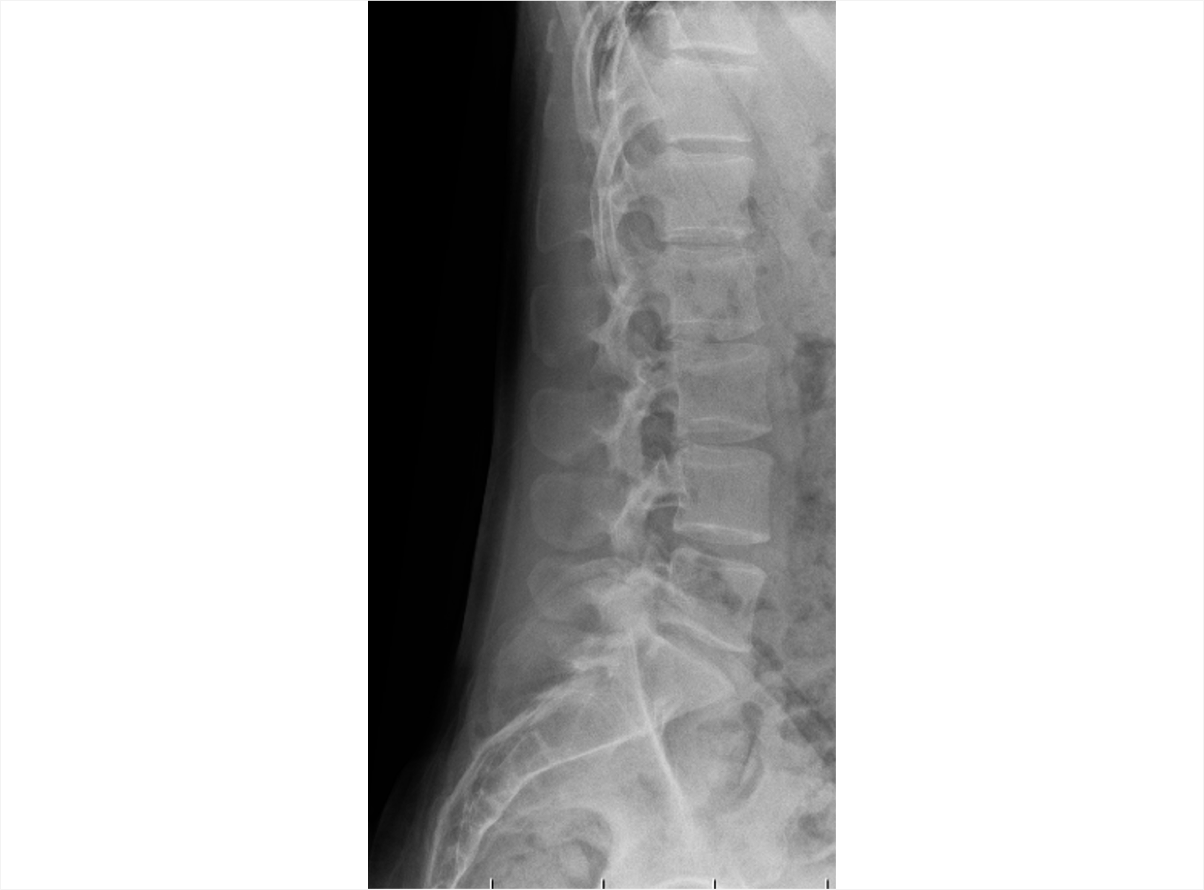 An X-ray of the lumbar spine