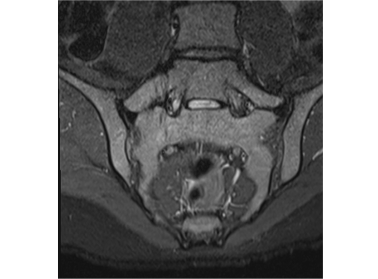 A normal MRI of the SIJs