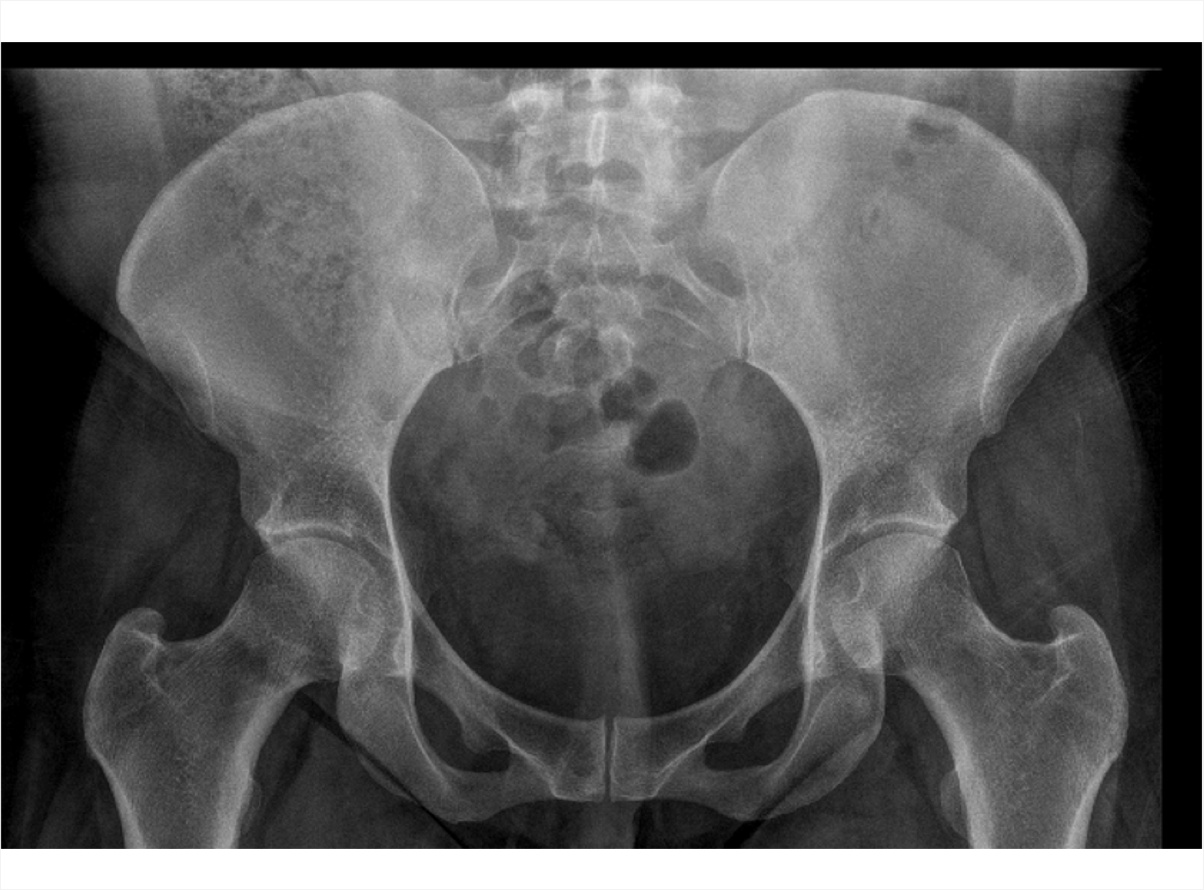 A normal X-ray of the SIJs