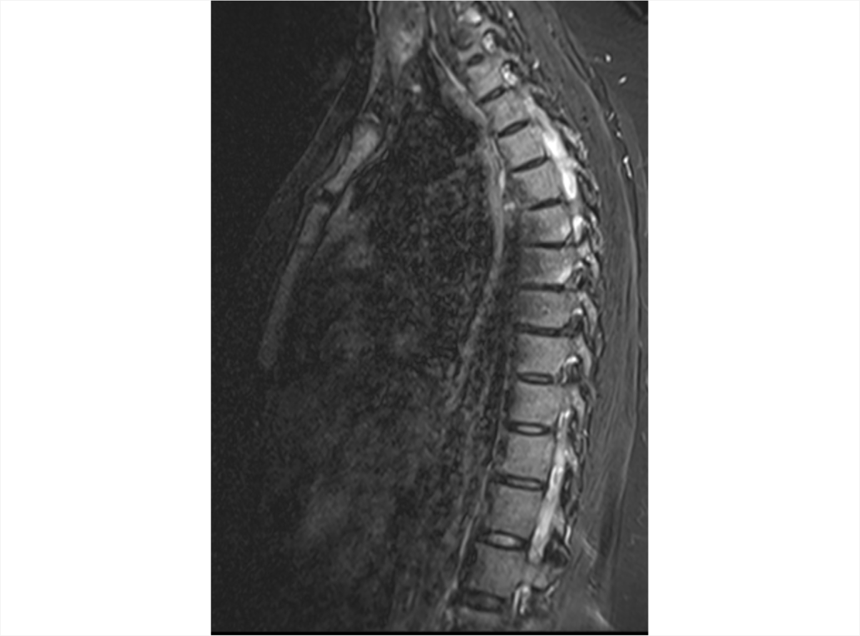 An MRI of the thoracic spine with bone marrow edema