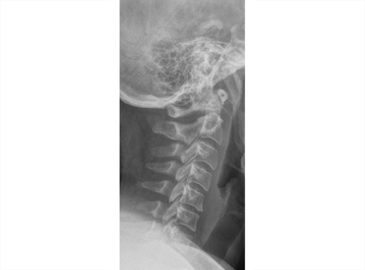 An X-ray of the cervical spine