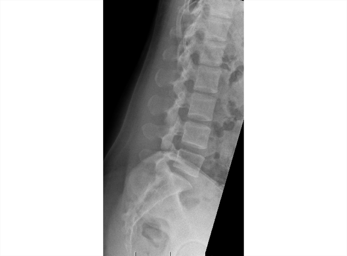 An X-ray of the lumbar spine
