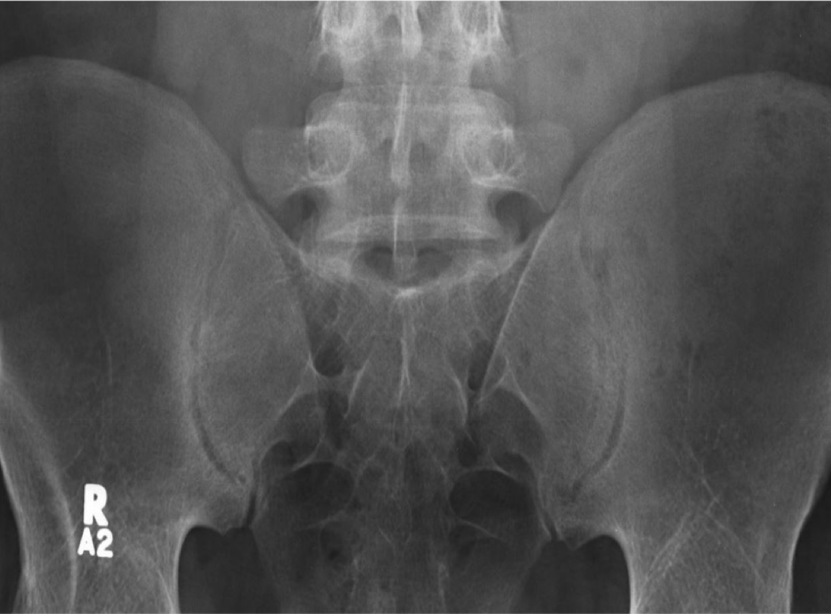 An X-ray of SIJ showing unilateral joint space narrowing