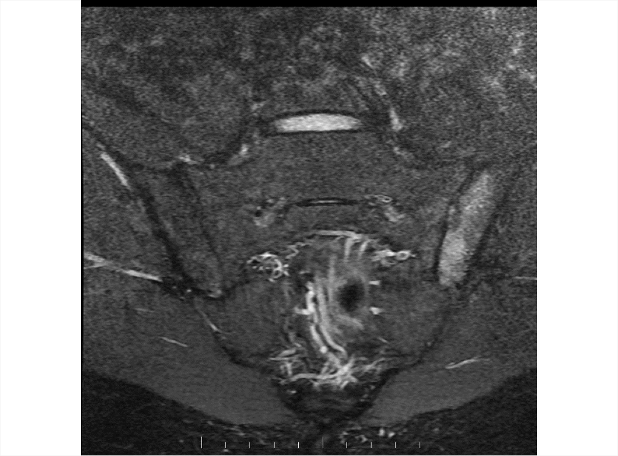 An MRI of SIJ showing bone marrow edema suggestive of unilateral sacroiliitis on the left