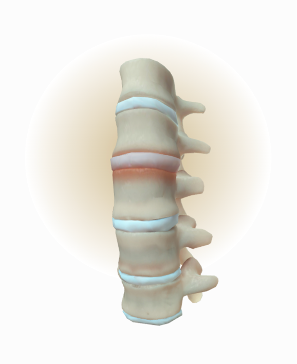 Skeletal changes in the spine depicting inflammation for nr-axSpA